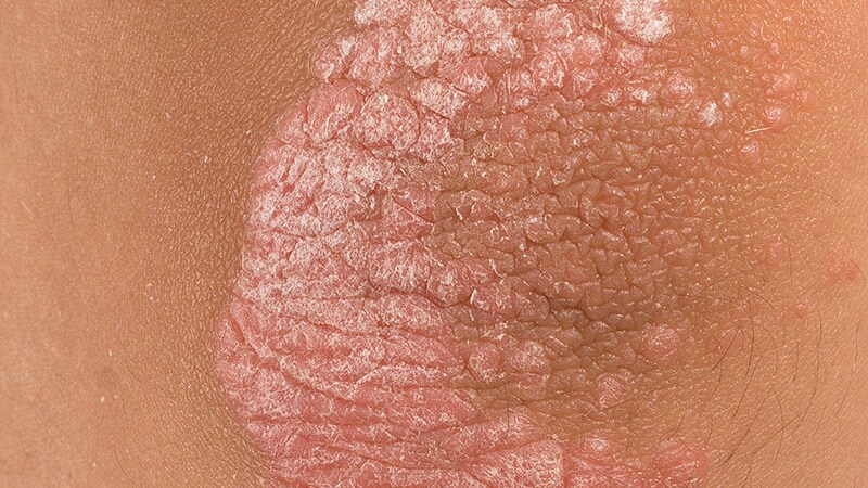 Psoriasis Care Deficiencies in Reproductive-Age Women