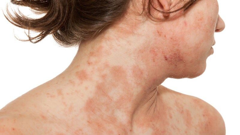 Novel Oral Agent Effective in Teens With Atopic Dermatitis