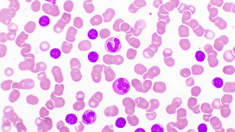 'Remarkable': CAR T Therapy for CLL/SLL