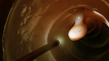 Margin Marking of Polyps Before EMR Cuts Recurrence: Study