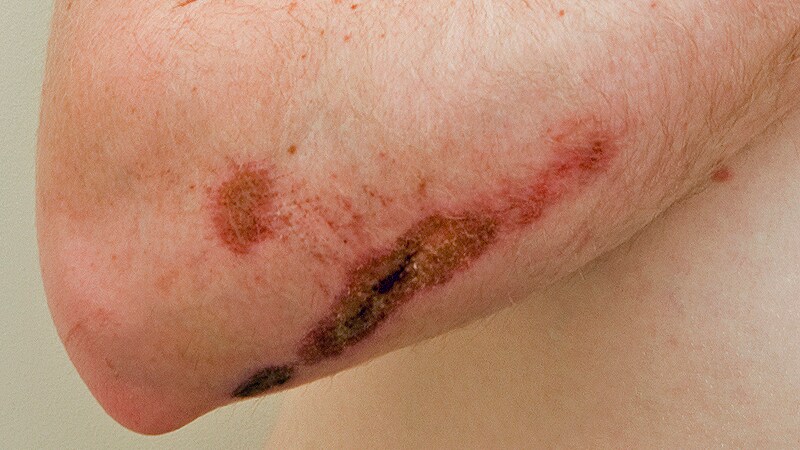 Fitusiran: Great 'Leap Forward' in Hemophilia Treatment