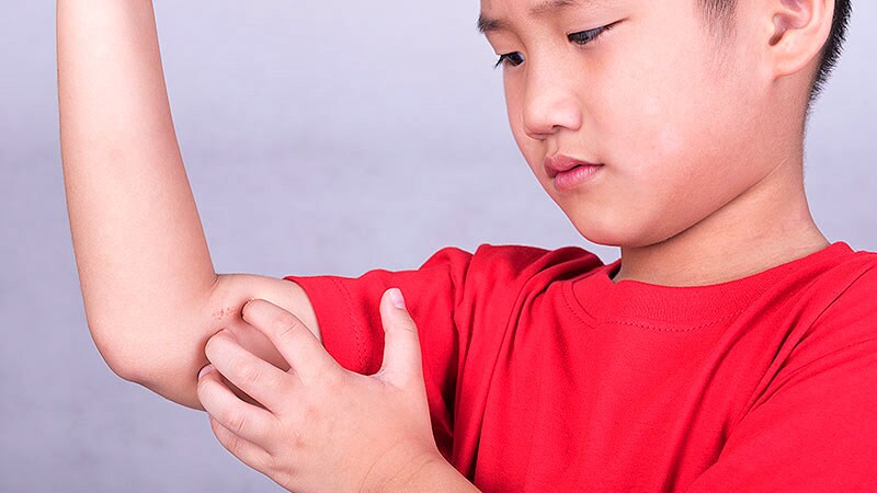 Biomarkers for Treatment Response Evaluated in Children With CSU