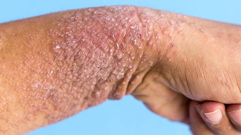 New Data Forecast More Oral PDE4 Inhibitors for Psoriasis