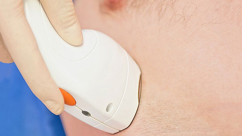 What Happens to Melanocytic Nevi During Laser Hair Removal?