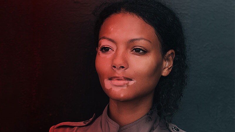 Lichen Sclerosus: Study Highlights Diagnostic Challenge