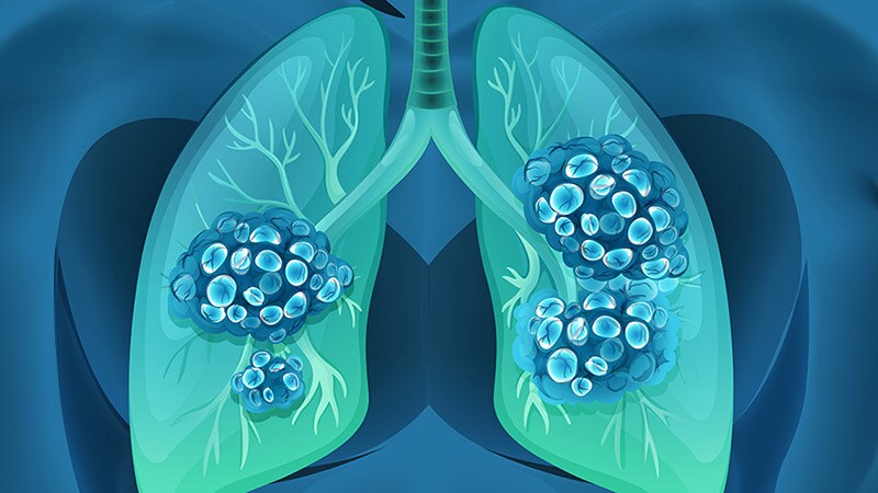 'We Finally Made It': Amivantamab Comes of Age in NSCLC