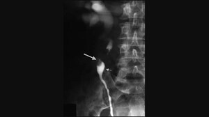 Neoadjuvant Chemo New SOC Option in Urothelial Carcinoma
