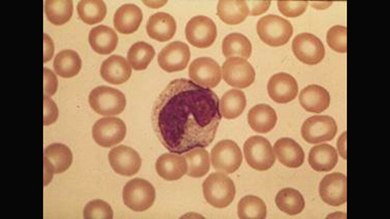 Mycophenolate Shows Promise in Immune Thrombocytopenia