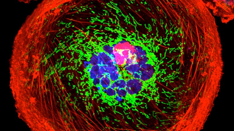 No Benefit to Adding ICI to Chemo in TNBC