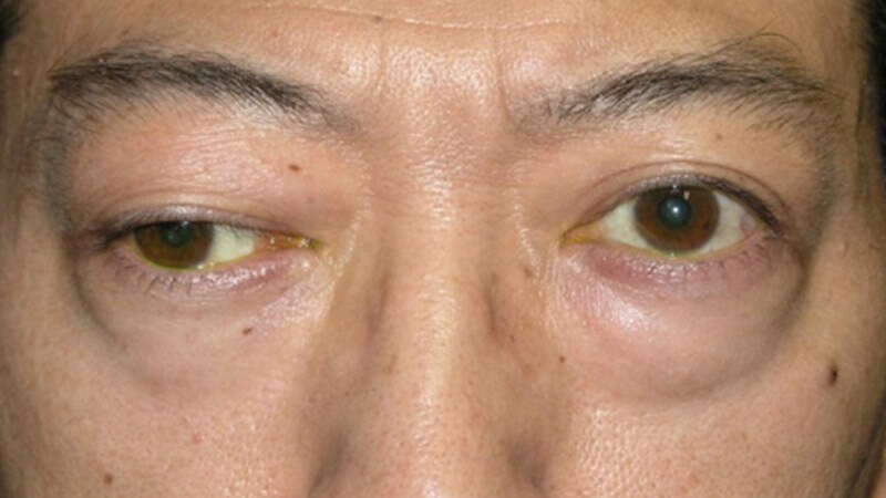 US Incidence, Prevalence of Myasthenia Gravis Rising