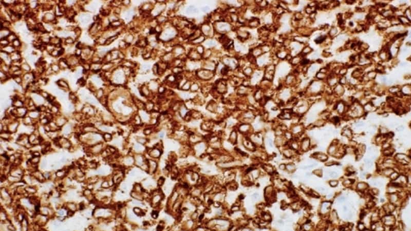 Allogeneic Transplant: Durable Remissions in T-Cell Lymphomas