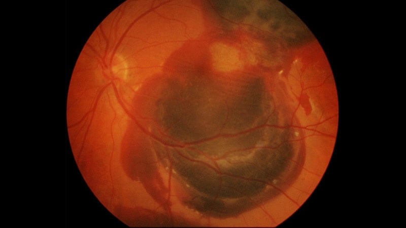 Faricimab Efficacy, Safety Hold Up in Real-World Study