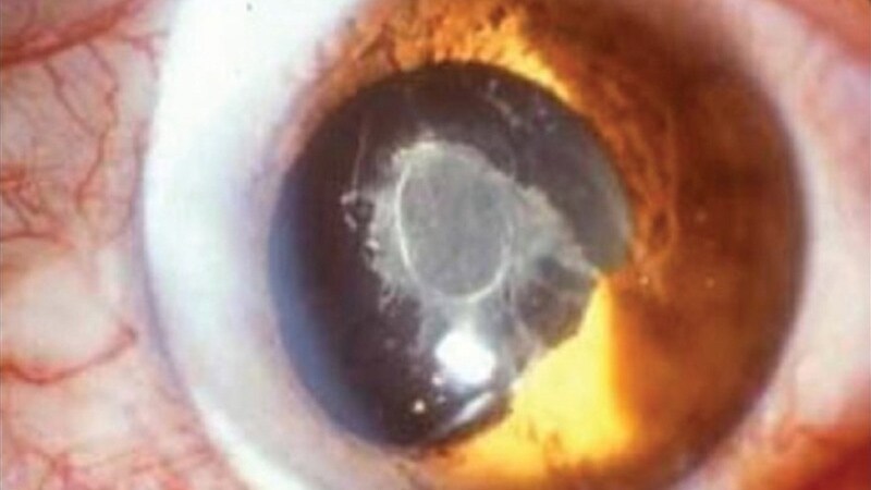 From Chronic Care to Zebras: Clinical Pearls in Uveitis 