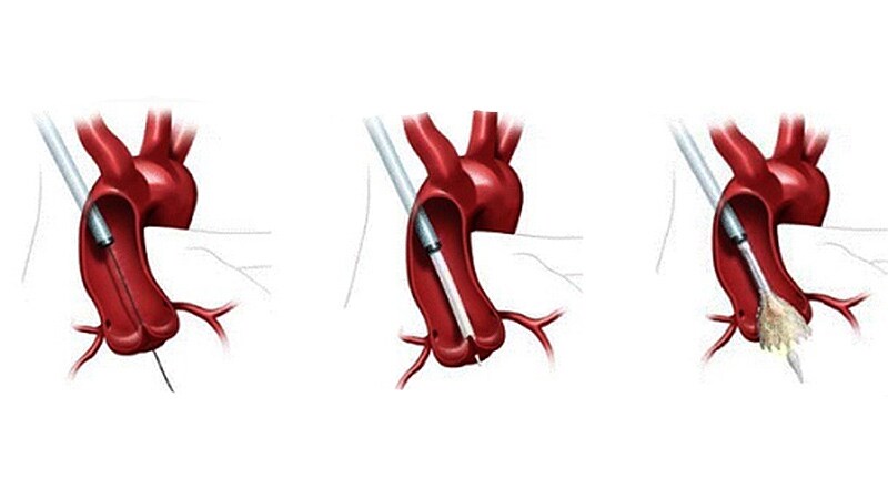 In Cardiogenic Shock, Edge-to-Edge Mitral Valve Repair Improves Outcome