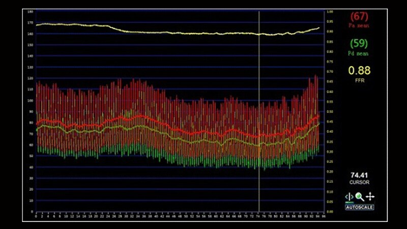 Stenotic Lesion Outcomes Better if FFR Guides PCI