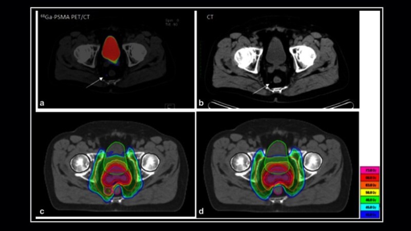 PSMA-PET/CT-Targeted Biopsy Enhances Prostate Cancer Planning