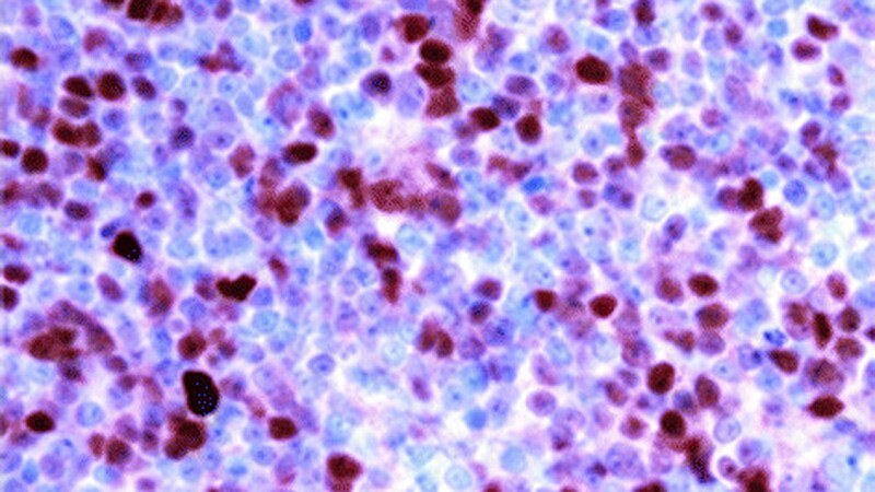 Duvelisib Response Rate 'Exciting' in Patients With r/r PTCL