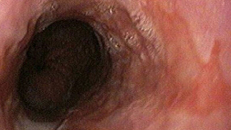 Does Anti-Reflux Surgery Cut Esophageal Cancer Risk?