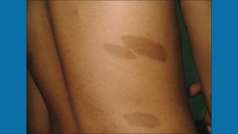 Diagnosing Neurofibromatosis 1, With and Without Genetic Testing