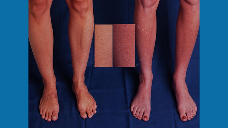 The First Signs of Elusive Dysautonomia May Appear on the Skin