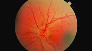 Gene Therapy Promising in Leber Hereditary Optic Neuropathy