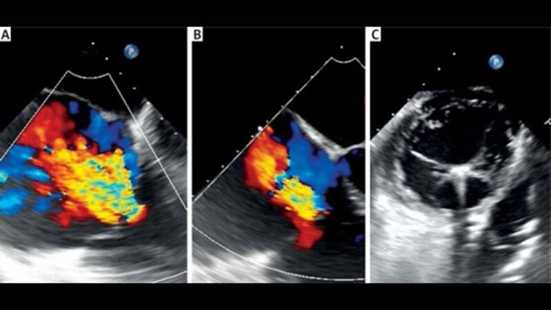 Pascal Tricuspid Repair Outcomes Durable at 1 Year: CLASP-TR