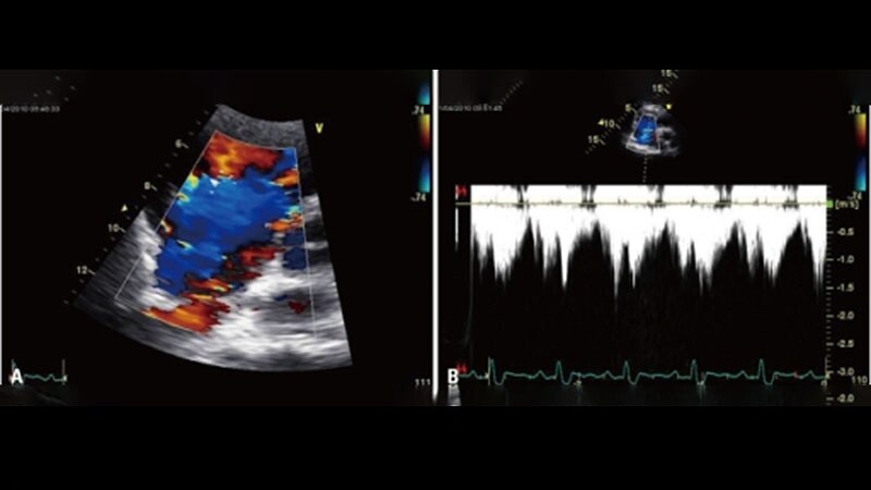 Transcatheter Tricuspid Valve Repair Effective, Safe for Regurgitation: TRILUMINATE