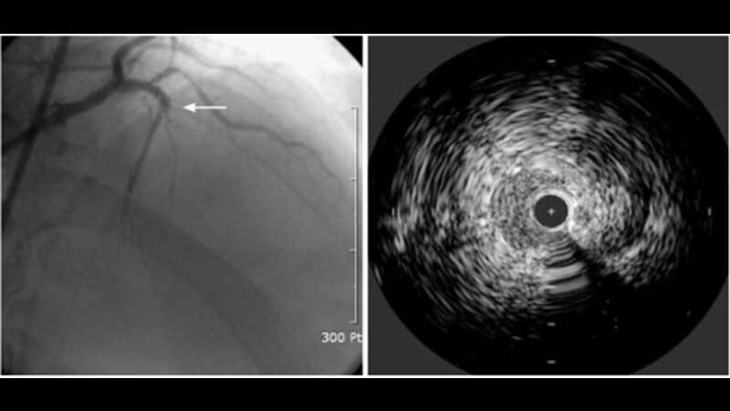 Intravascular Imaging Bests Angiography for Complex PCI
