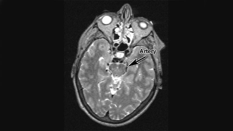 Novel Continuous Infusion System Promising for Parkinson's
