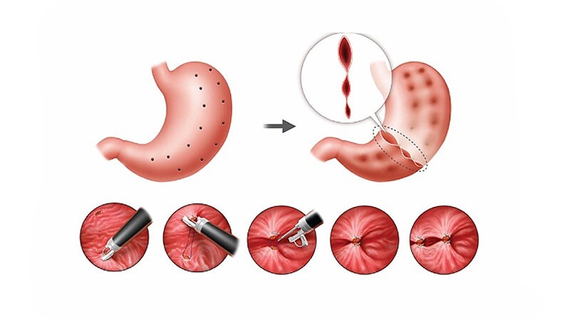 ESG Plus Obesity Drugs Add Up to More Weight Loss