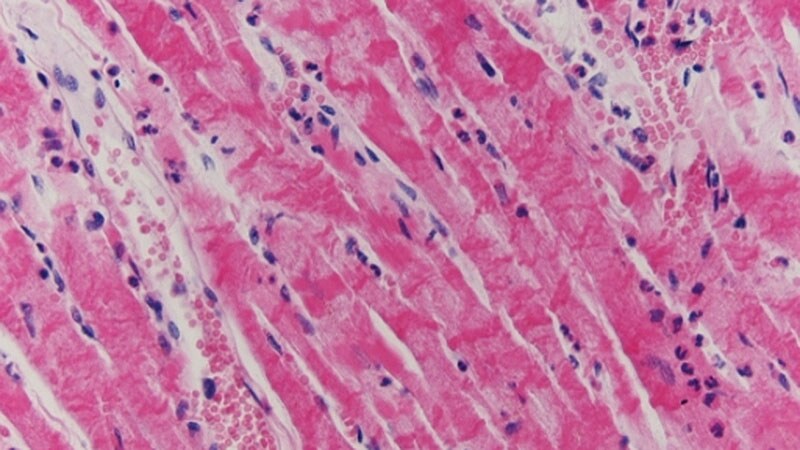 Anti-inflammatory Strategy in Acute Myocarditis — No Benefit