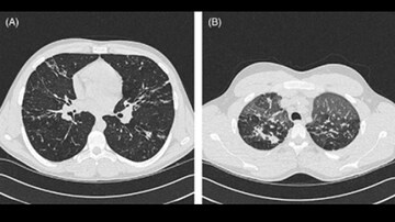 Beyond CF: Genetics of PF and Other Lung Diseases
