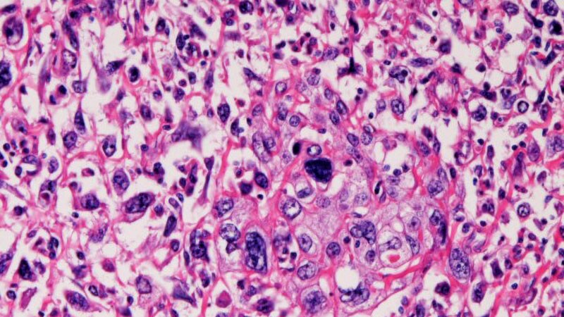 Combo Therapy Hailed as Standard for Urothelial Carcinoma