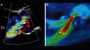 Trilogy TAVR Safe, Effective in Aortic Regurgitation