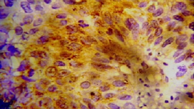 Induction Chemo Extends Survival in Cervical Cancer