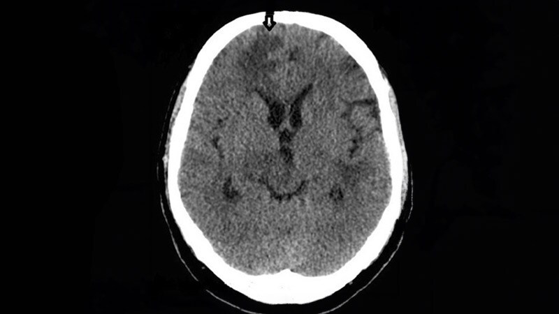 Mixed Results With Cognitive Training in HIV