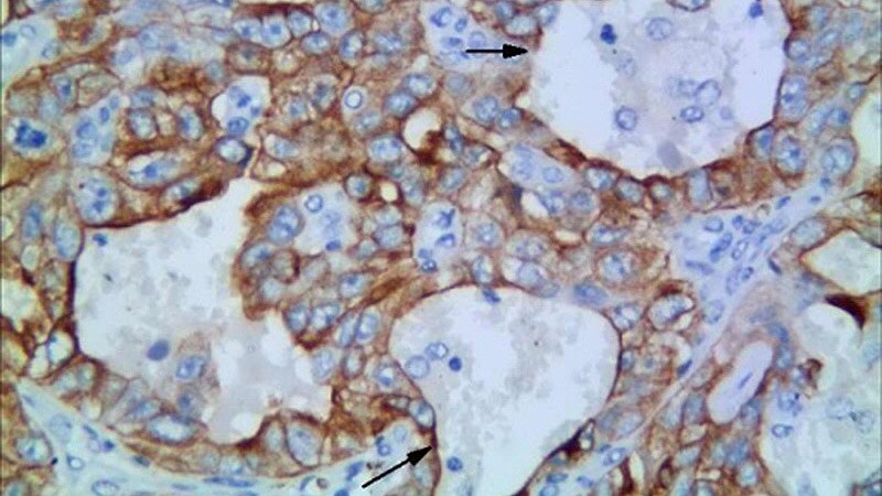 ESMO 2023: Tarlatamab Shows Promise for Small Cell Lung Cancer 