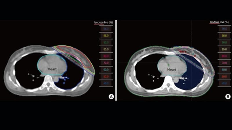 ASTRO Updates on Partial Breast Irradiation in Early Cancer 