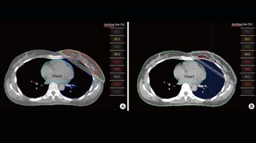 ASTRO Updates on Partial Breast Irradiation in Early Cancer 