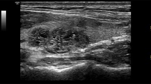Assessing Thyroid Nodules: A Clinician's Guide