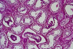 Cryptorchidism Imaging: Overview, Computed Tomography, Magnetic Resonance Imaging