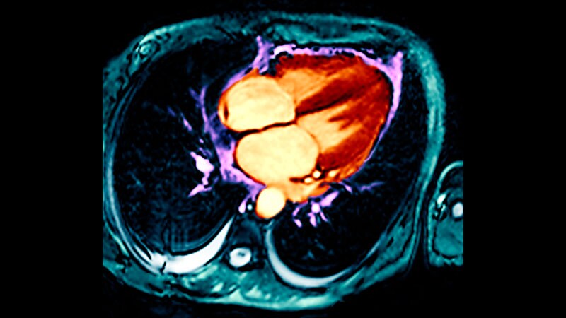 MitraClip Effective for Post-MI Acute MR With Cardiogenic Shock