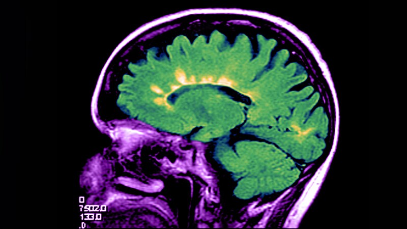 Fast Five Quiz: Managing Progression of Relapsing-Remitting MS