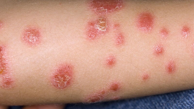 Consider Itch and Joint Pain in Pediatric Psoriasis Patients