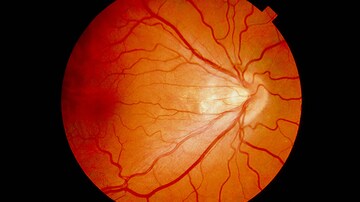 Aflibercept Matches Laser for Retinopathy of Prematurity