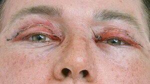 Tranexamic Acid Found to Reduce Bruising in Blepharoplasty