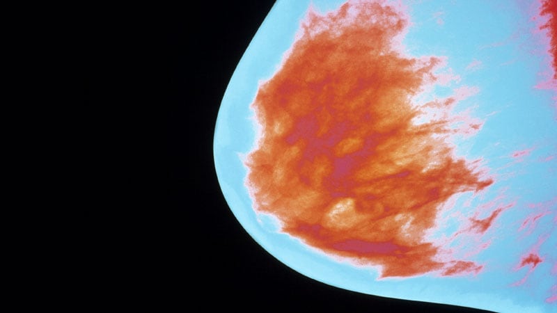 Fast Five Quiz: Advanced Insights Into HR-Positive, HER2-Negative Breast Cancer Adjuvant Therapy