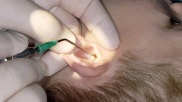 ENTs Discourage Ear Tubes for Recurrent AOM Without Effusion