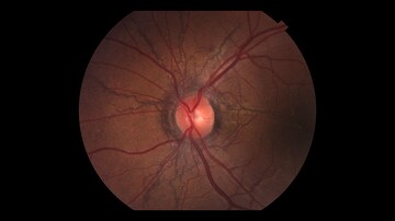 Vision Rehab Helps People With Low Vision Navigate the World