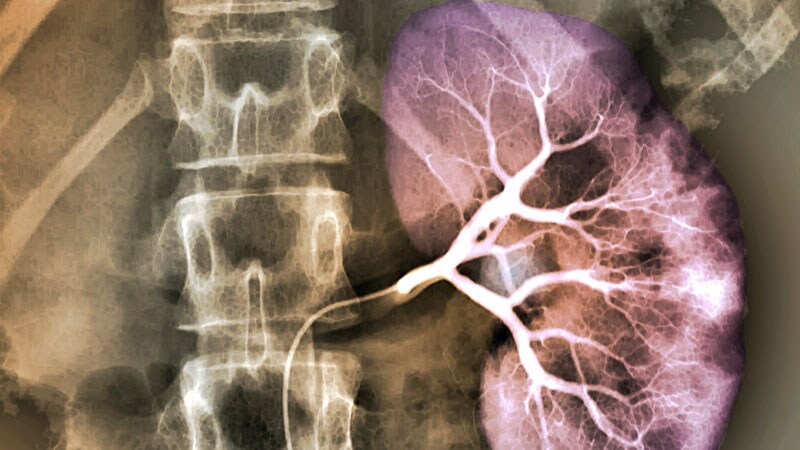 Ultrasonic Renal Denervation Passes Key HTN Test: RADIANCE II